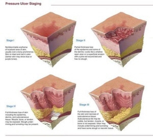 왼쪽 상단에서부터 시계방향으로 1단계, 2단계, 3단계, 4단계 욕창 증상/사진=이일재 교수 제공