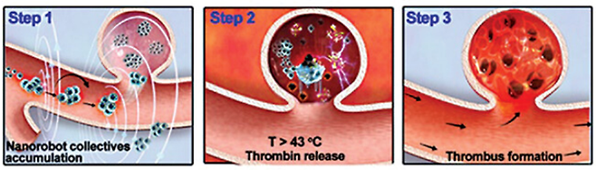 실험동물인 토끼 몸속에 들어온 나노로봇이 부푼 풍선처럼 생긴 뇌동맥류 내부로 유입되고 있다(왼쪽 그림). 나노로봇에 열을 가하자 혈액 응고제가 쏟아져 나온다(가운데 그림) .혈액 응고제가 뇌동맥류 내부를 가득 메워 치료 효과를 낸다(오른쪽 사진).