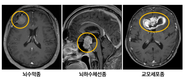 뇌수막종(왼쪽부터), 뇌하수체선종, 교모세포종 환자의 뇌 MRI 검사 사진에서 뇌종양(노란색)이 관찰됐다. 사진 제공=서울아산병원