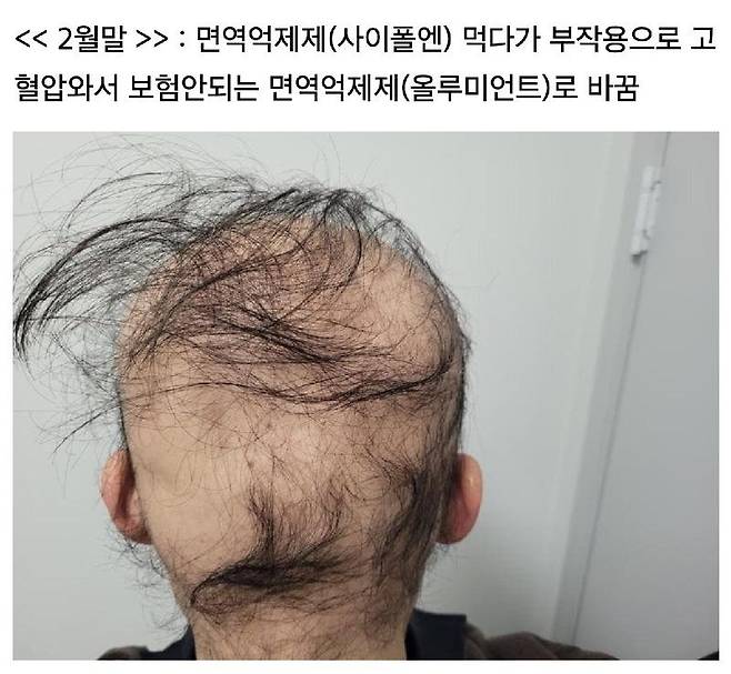 333.jpg 원형탈모 치료하다가 급성 탈모로 여친과 헤어짐.jpg