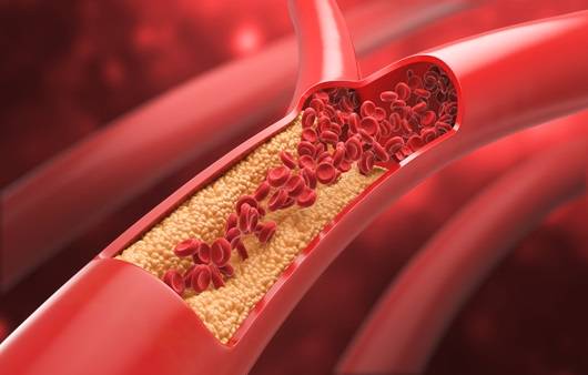 2차성 이상지질혈증의 원인으로 음식, 질환, 약물 3가지가 지목됐다|출처: 게티이미지뱅크