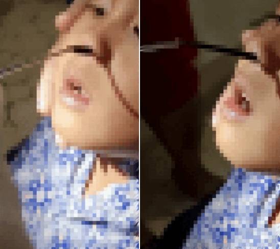 인도네시아 10세 소년의 코에서 살아있는 거머리가 발견됐다. 이 거머리는 아이의 콧속에서 한 달 가량 살았던 것으로 드러났다. /사진=docnhanh