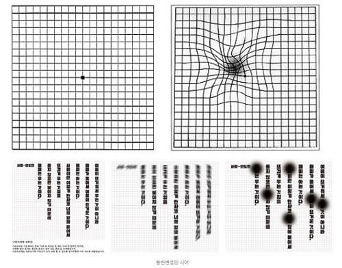 황반변성에 의한 변형시 모습  [자료사진]