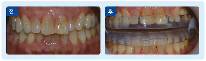 수면무호흡증을 치료하는 '구강내 장치' 착용 전후 사진./사진=강동경희대병원