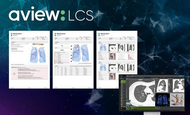 폐암 검진 AI 솔루션을 사용한 환자용 검사 결과지 예시. 코어라인 제공