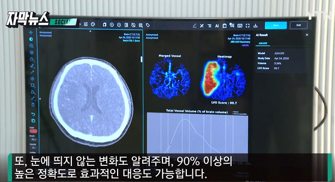 image.png 뇌졸중 전문가 의사 vs 인공지능, 뇌졸중 진단 대결