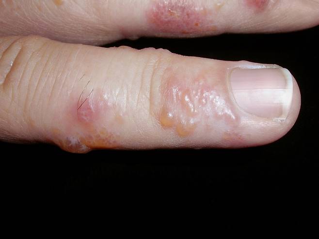 손가락에 주로 나타나는 한포진은 주로 스트레스나 피로, 다한증, 여러 자극 물질 등에 의해 발생한다./사진=클립아트코리아