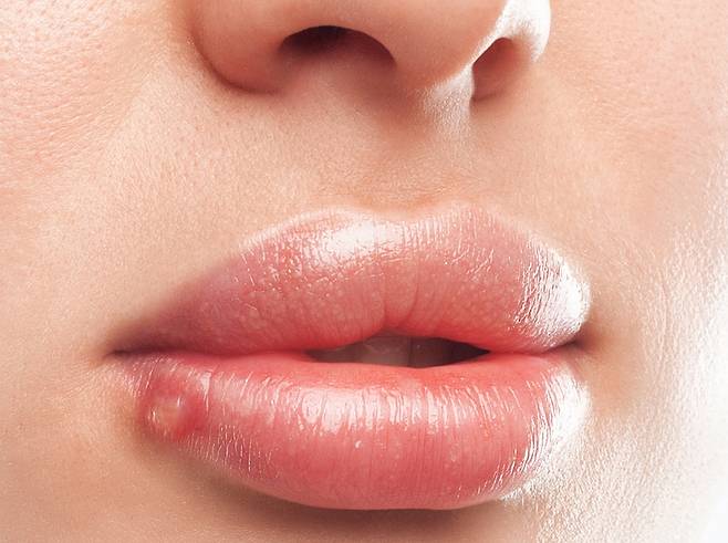 피곤할 때마다 올라오는 입술 물집은 성병이 아니다. 헤르페스 1형 감염으로, 입 주변에 단순 포진이 생기는 것이다./사진=게티이미지뱅크