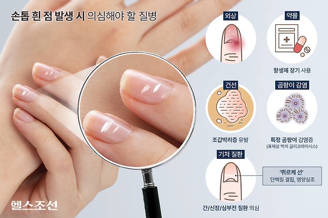 손톱이나 발톱의 흰 반점은 외상뿐만 아니라, 다양한 질환의 징후일 수도 있다./그래픽=김민선