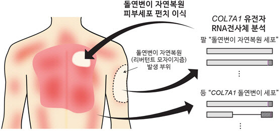 RDEB 환자 대상 유전자 돌연변이 자연 복원 피부세포 자가이식 치료 과정 모식도.