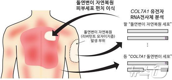 RDEB 환자 대상 유전자 돌연변이 자연 복원 피부세포 자가이식 치료 과정 모식도/강남세브란스병원 제공