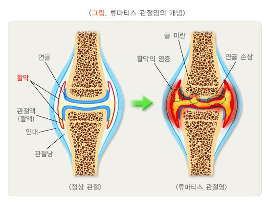 류마티스 관절염 개념도./질병관리청