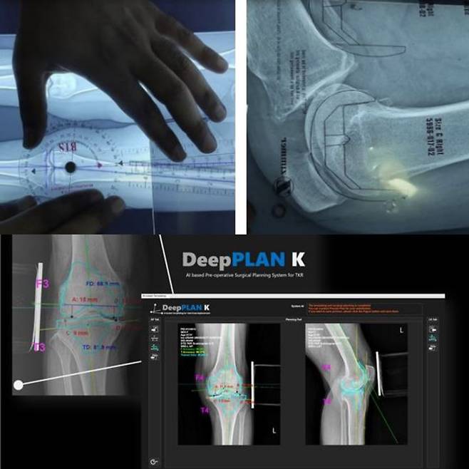 [서울=뉴시스] 카비랩의 대표 솔루션 가운데 하나인 인공지능(AI) 기반 소프트웨어 의료기기 딥플랜케이는 인공 무릎관절 전체 교체 수술 전 환자의 엑스레이(X-ray) 영상을 활용해 환자 맞춤 인공관절 사이즈를 도출해 최적의 수술계획을 제공한다. 사진은 기존 정형외과 템플레이팅(수술계획)과 카비랩 딥플랜케이 활용 예시 모습. (사진=카비랩 제공) 2024.11.01. photo@newsis.com *재판매 및 DB 금지