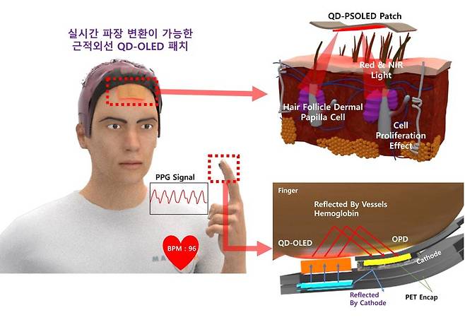 가천대 전용민·권상직·조의식 교수팀과 ㈜이노큐디, 충북대 권정현 교수팀이 개발한 QD-OLED 패치를 탈모가 진행중인 머리에 붙이면 두피 아래 모낭에 있는 모유두 세포를 늘리는데 효과가 있으며, 심박을 측정하는 센서로 만들 수 있다. 연구재단 제공