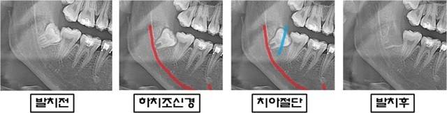 하치조신경을 피해서 사랑니 치아를 절단한 후 발치한 X-ray 사진 | 출처: 림플란트치과의원