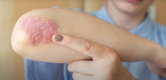 ◇건선은 질병의 이름 때문에 단순히 피부가 건조해서 생기는 피부질환으로 오해하는 경우가 많지만 실제로는 자가면역질환이다. 사진출처=미국국립보건원(NIH)