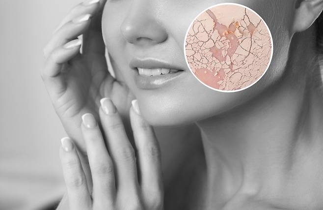 악건성 피부는 환절기에 각질층의 수분 함량이 줄어들면서 하얗게 들뜨거나 거칠어진다.​/사진=게티이미지뱅크