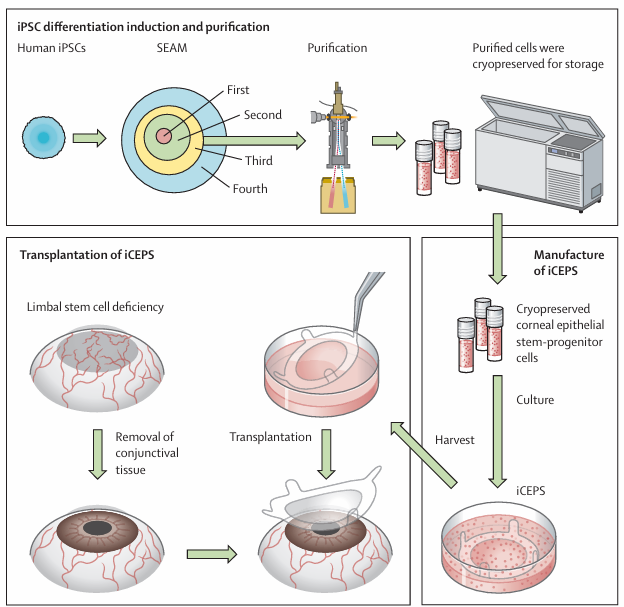 일본 연구진의 실험 과정입니다. 혈액 세포를 이용해 줄기세포를 만들고, 이를 환자의 안구에 넣었습니다. [사진=랜싯]