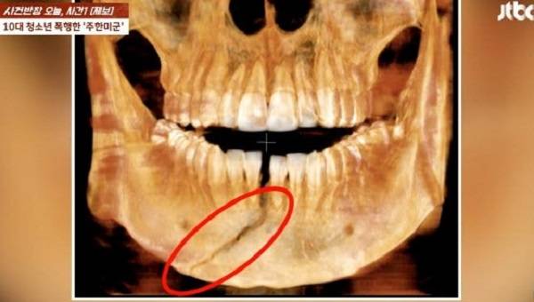 30대 주한미군 중사에게 가격당해 턱뼈가 골절된 10대 소년의 엑스레이 사진. JTBC 보도화면 캡처