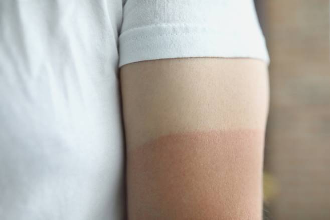피부 손상에 대한 자가 대응으로 멜라닌 색소가 계속해서 생성되면 탄 피부가 원래대로 돌아오는 데 오래 걸릴 수 있다./사진=게티이미지뱅크