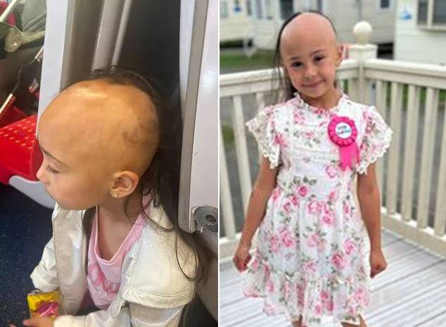 3살부터 머리카락이 빠지기 시작해 뒤통수에 머리카락 한 가닥만 남은 7살 소녀 사연이 보도됐다. [사진=영국 매체 미러 보도 갈무리]