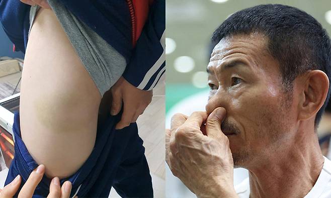 손웅정 SON축구아카데미 감독(오른쪽)을 아동학대 혐의로 고소한 학생 측이 사건 발생일 이후 사흘이 지난 3월12일 촬영한 멍자국. 연합뉴스