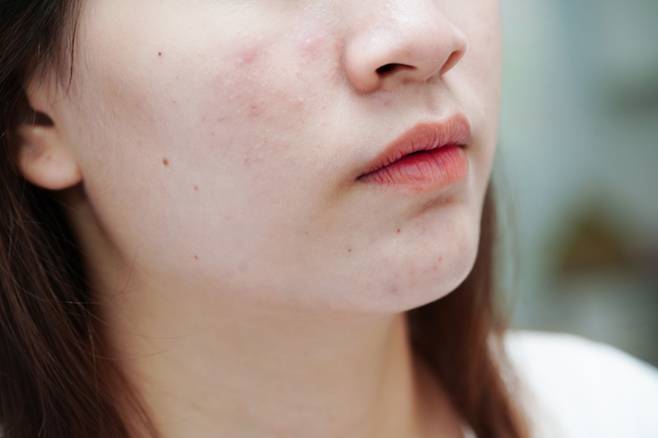 생리 시작 3~4일 전부터 탄수화물과 단순당이 많이 든 식품을 적게 먹고, 유분이 적은 화장품을 쓰면 생리 도중 트러블이 덜 생기게 할 수 있다./사진=게티이미지뱅크