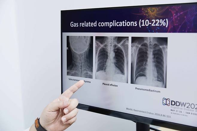 식도이완불능증이 있으면 하부식도괄약근압이 비정상적으로 높아져 음식물이 식도로 내려가지 않고 고이면서 여러 합병증을 유발하기도 한다./사진=신지호 기자