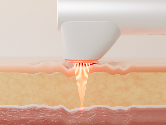 하이포커스샷의 원리/사진제공=에이피알