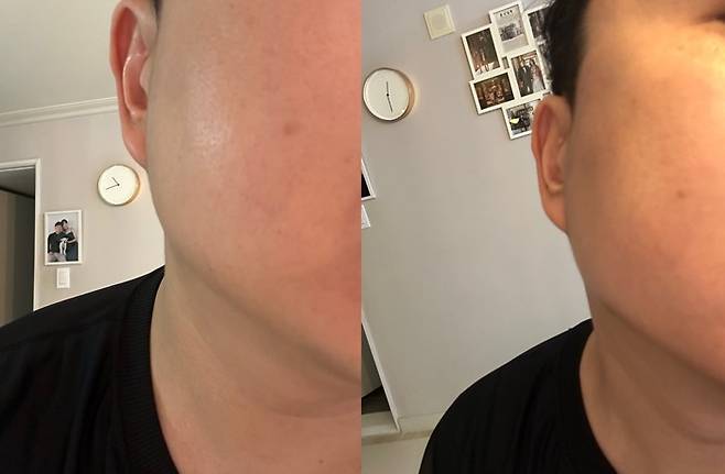 하이포커스샷 사용 전(왼쪽)과 4주 사용 후(오른쪽) 턱선 비교./사진=김아름 기자 armijjang@