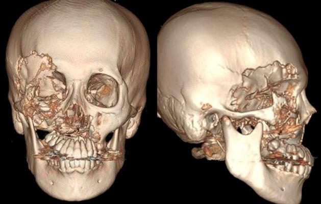 고함-스타우트병이 얼굴에 나타난 환자의 스캔 사진./사진=Internal Medicine