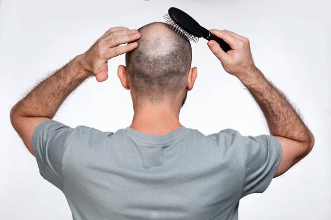 탈모 증상이 있으면 고민할 수밖에 없다. 간헐적 단식이 모발 성장을 억제할 수 있다는 연구 결과에도 관심을 가져야 할 것 같다. [사진=게티이미지뱅크]