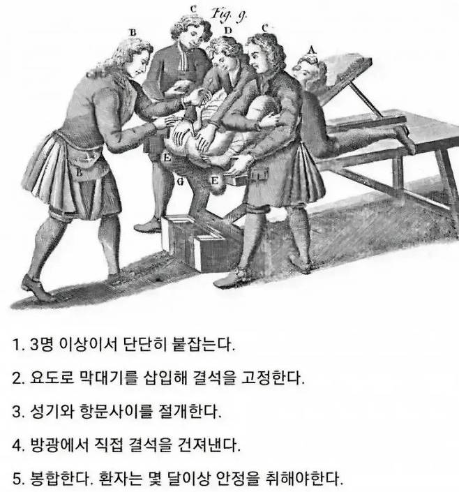 중세시대 요로결석 치료법