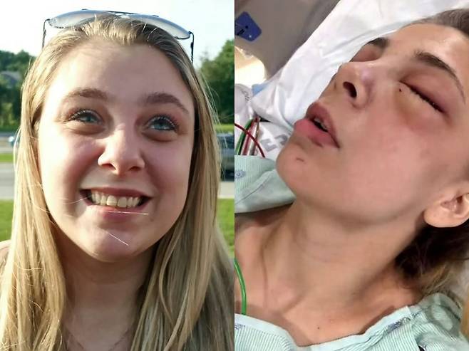 케일리 머트하트(20)는 메스암페타민을 과도하게 투여해 몇 시간 동안 환각에 빠졌는데, 이때 스스로 눈을 없애는 사고가 발생했다. 의안을 이식한 머트하트 모습(왼쪽)과 의안 이식 전 입원했던 머트하트 모습(오른쪽)./사진=피플, 데일리메일