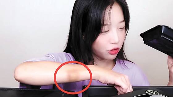 YouTuber Tzuyang with a bruise on her right arm [SCREEN CAPTURE]