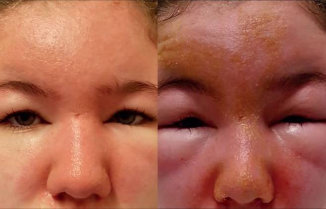 여드름 연고를 바르고 얼굴이 서서히 부어 응급실을 찾았을 당시 A양의 모습(왼쪽)과 입원 후 증상이 더욱 극심해진 모습. Ulster Medical Society