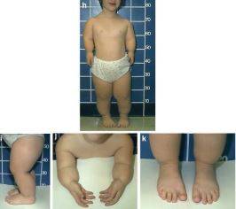 레리-웨일 증후군 환자들은 사지의 중간 부분, 즉 종아리와 팔뚝이 다른 부분에 비해 상대적으로 짧은 특징을 보인다./사진=Atlas of Genetic Diagnosis and Counseling