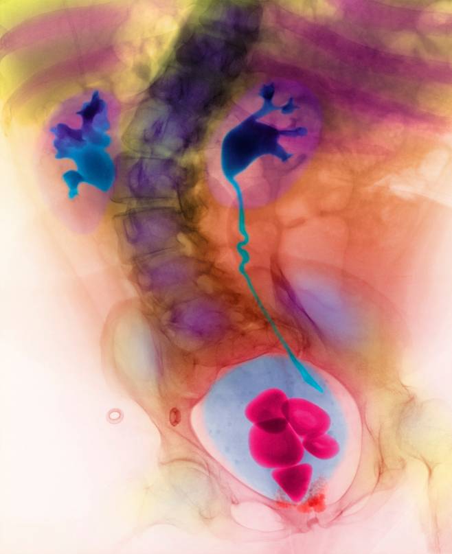 신장, 요관, 방광 등이 보이는 결석 영상 검사 사진./클립아트코리아