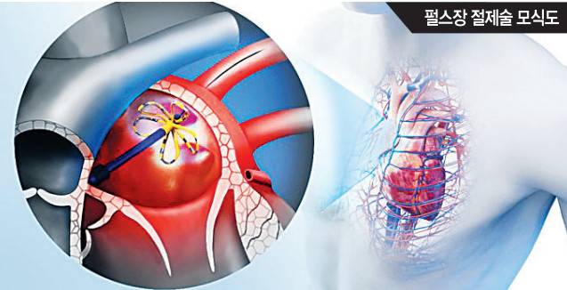 심장의 병변 부위에 위치시킨 카테터를 통해 강한 전기 쇼크를 줘서 심근세포를 파괴하는 펄스장 절제술 모식도. 삼성서울병원 제공