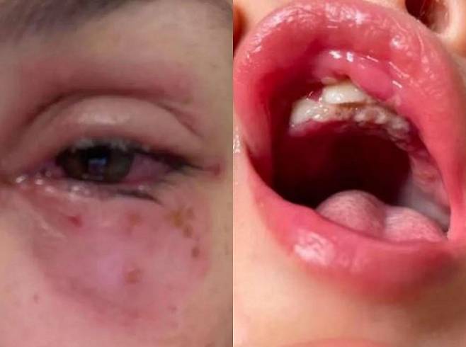 호주의 한 여성이 아들에게 헤르페스 바이러스를 옮아 눈에 스텐트 삽입술까지 받은 사연이 공개됐다./사진=뉴욕포스트