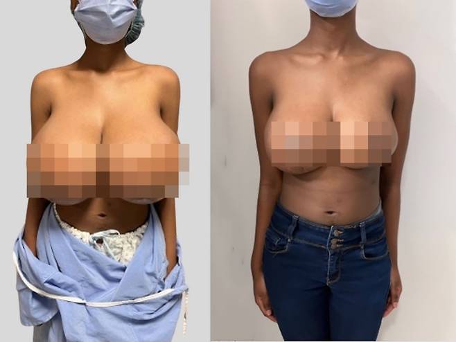 코로나19 화이자 백신을 맞고 가슴이 커지는 증상을 겪은 캐나다 10대 여성 A씨. 사진= Plastic & Reconstructive Surgery-Global Open 캡처/ 캐나다 토론토대학교