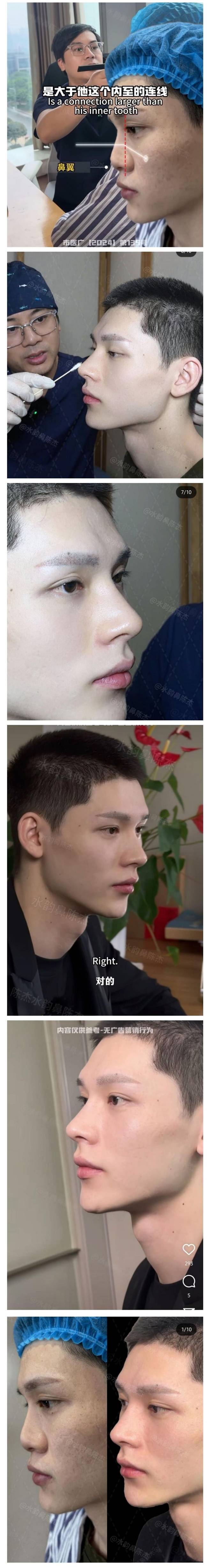 34e137125ed0d409e72278f88d8a630c11719d78.jpg 남자 코수술 비포-에프터