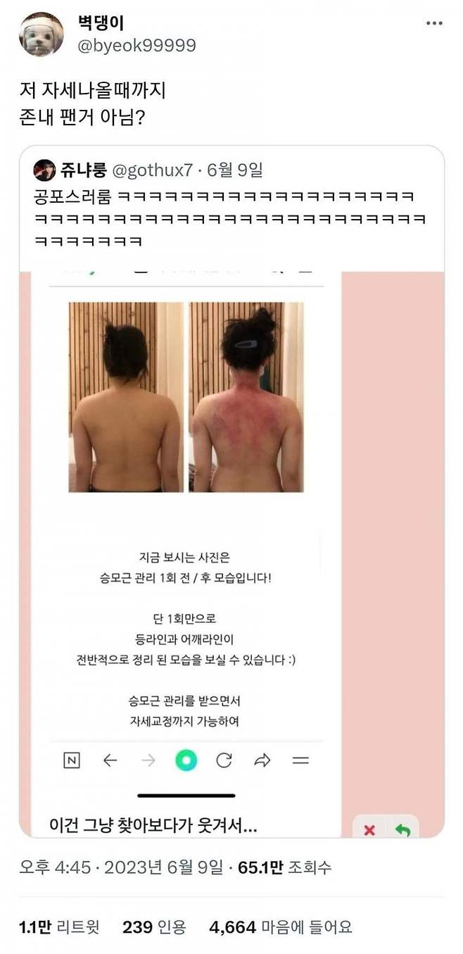 자세 교정 전후사진