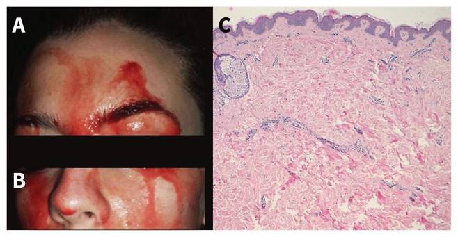21세 여성의 이마(A)와 눈 아랫부분(B)에서 출혈이 발생했다. (C) 출혈 부위의 조직학적 분석은 정상 피부임을 보여줬다.헤마톡실린-에오신 염색, 확대 × 20)[캐나다의학협회저널 캡쳐]