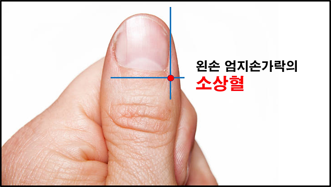 심하게 체했을 때 엄지손가락 안쪽 손톱뿌리에 위치한 소상혈(少商穴)을 일회용 사혈침으로 찔러 피를 내면 효과가 있다. 이것을 보통 ‘손따기’라고 한다.