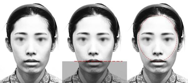 '중안부 긴 얼굴'의 본질은 '길어 보이며, 턱 끝이 뒤로 후퇴한 얼굴' 입니다.  턱 끝이 뒤로 후퇴하면 입 아래쪽에 그늘이 생기고, 상대적으로 밝은 중안부와 인중이 두드러지며 길어 보이게 됩니다.