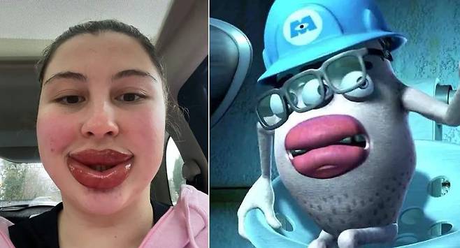 영국의 20대 여성이 입술문신을 받은 직후 퉁퉁 부어오른 입술 사진을 공유했다. 오른쪽 사진은 픽사 애니메이션 몬스터 주식회사 '제프 펑거스'. 출처=뉴욕포스트