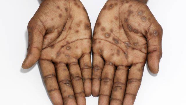 최근 성매개 감염병 환자수가 증가하고 있다 | 출처: 클립아트코리아