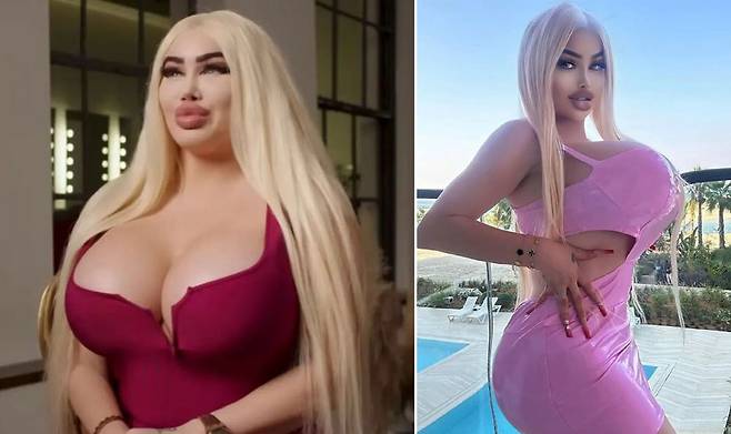 네덜란드의 한 20대 여성이 4억 원을 들여 성형수술을 하며 각종 부작용을 겪었다고 밝혀 화제다./사진=뉴욕포스트