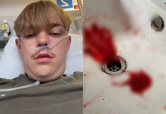 12살 때부터 액상형 전자담배를 피워온 제이든 리처드슨(17)은 액상형 전자담배 관련 폐손상 진단(EVALI)을 받았다./사진=더 미러